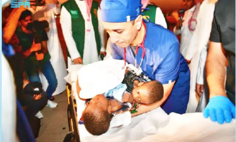 siamese twins siamese twins