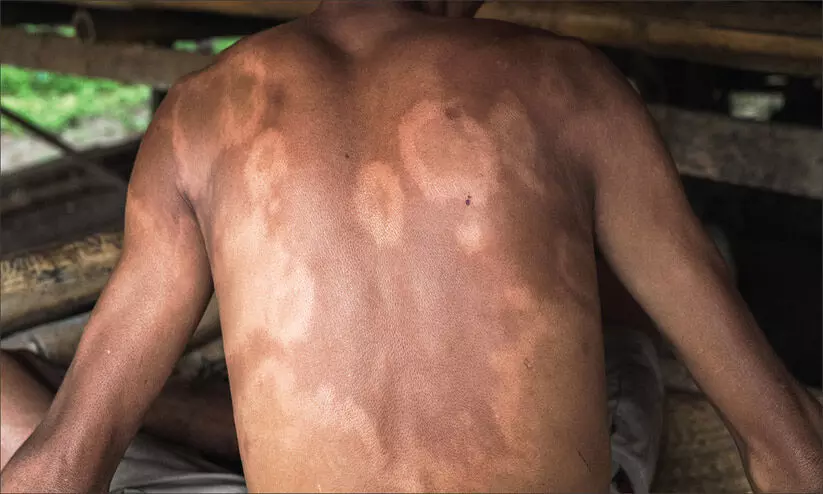 കുട്ടികളിലെ കുഷ്ഠരോഗബാധ തടയാൻ ബാലമിത്ര കാമ്പയിൻ