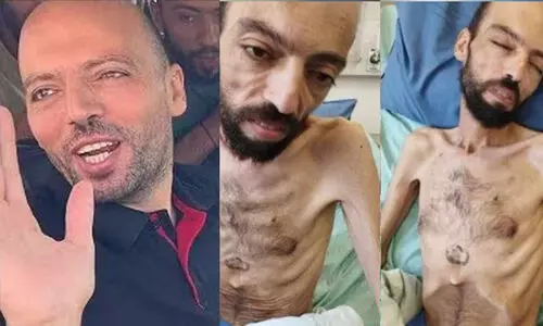 172 ദിവസം നിരാഹാര സമരം ചെയ്ത ഫലസ്തീൻ തടവുകാരനെ ഇസ്രായേൽ മോചിപ്പിച്ചു