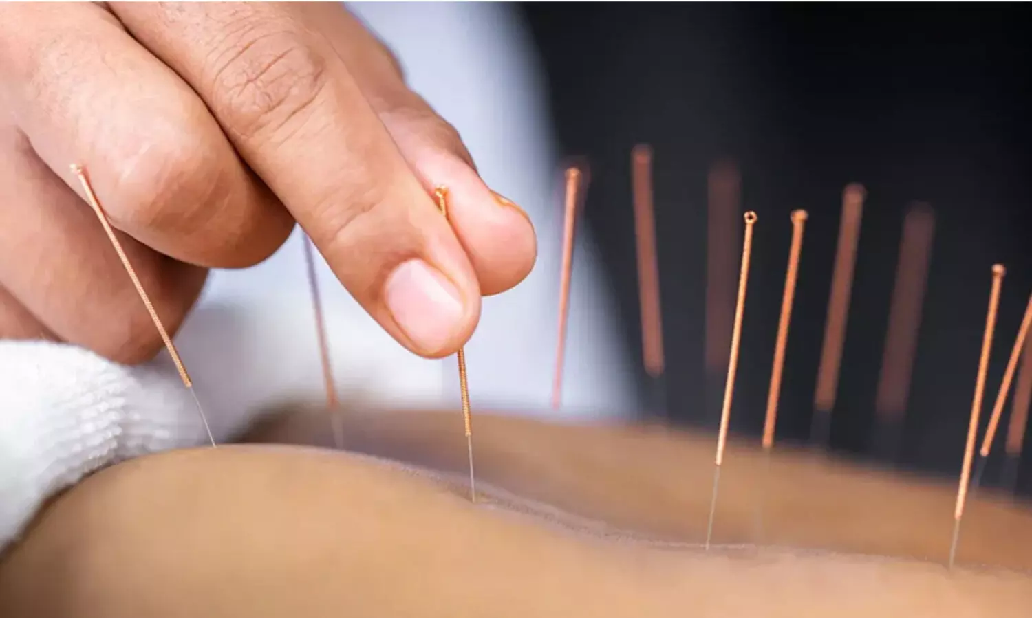 അക്യുപങ്ചര്‍ സൂചി ഉപയോഗിച്ചതിലെ പിഴവ്, ശ്വാസകോശം ചുരുങ്ങി 63കാരി ഗുരുതരാവസ്ഥയിൽ