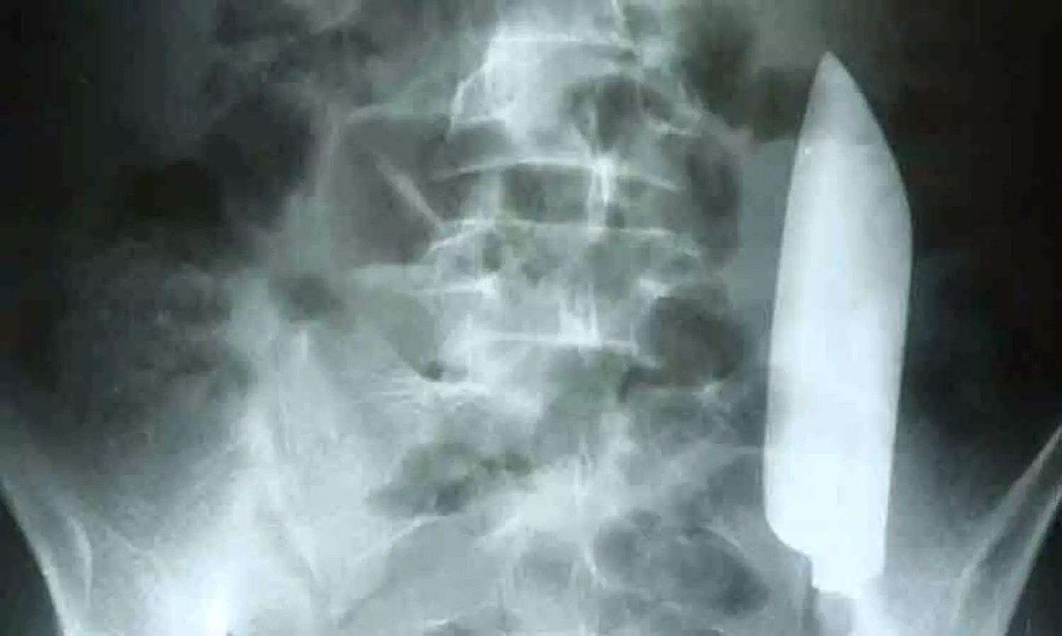 വയറുവേദനയുമായെത്തിയ യുവാവിന്റെ വയറ്റിൽ നിന്ന് പുറത്തെടുത്തത് കത്തി