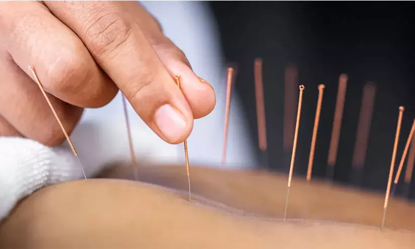 അക്യുപങ്ചര്‍ സൂചി ഉപയോഗിച്ചതിലെ പിഴവ്, ശ്വാസകോശം ചുരുങ്ങി 63കാരി ഗുരുതരാവസ്ഥയിൽ