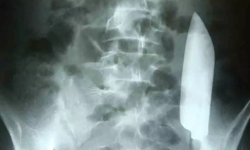 വയറുവേദനയുമായെത്തിയ യുവാവിന്റെ വയറ്റിൽ നിന്ന് പുറത്തെടുത്തത് കത്തി വയറുവേദനയുമായെത്തിയ യുവാവിന്റെ വയറ്റിൽ നിന്ന് പുറത്തെടുത്തത് കത്തി