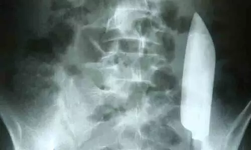 വയറുവേദനയുമായെത്തിയ യുവാവിന്റെ വയറ്റിൽ നിന്ന് പുറത്തെടുത്തത് കത്തി