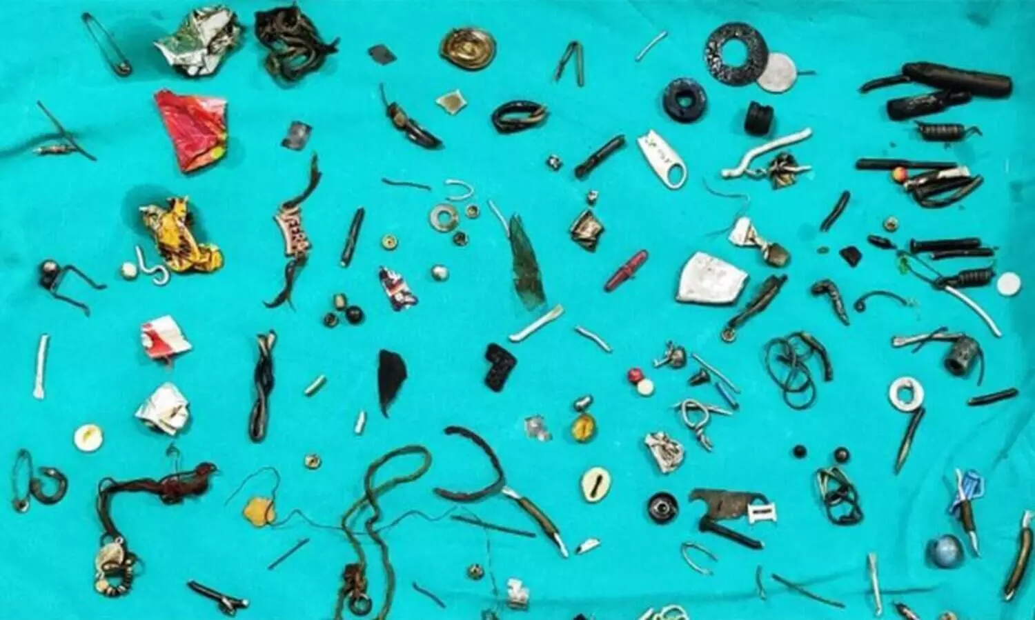 ഇയർഫോൺ മുതൽ സേഫ്​റ്റി പിന്നും കാന്തവുംവരെ; വയറുവേദയുമായെത്തിയ രോഗിയുടെ വയറ്റിൽനിന്ന്​ നീക്കംചെയ്തത്​ വിചിത്ര വസ്തുക്കൾ