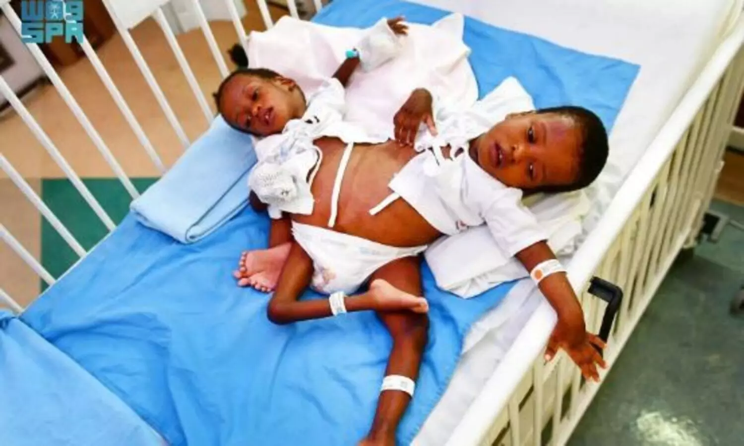 ടാൻസാനിയൻ സയാമീസ് ഇരട്ടകളെ വേർപ്പെടുത്തൽ ശസ്​ത്രക്രിയ നാളെ