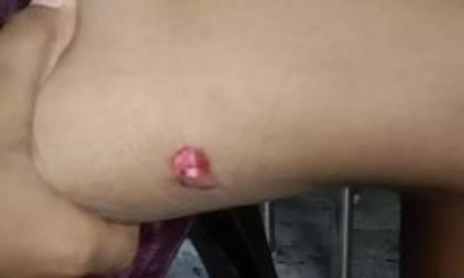 stray dog attack Mannar