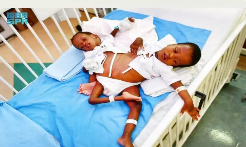 Tanzanian conjoined twins Hassan and Hussain