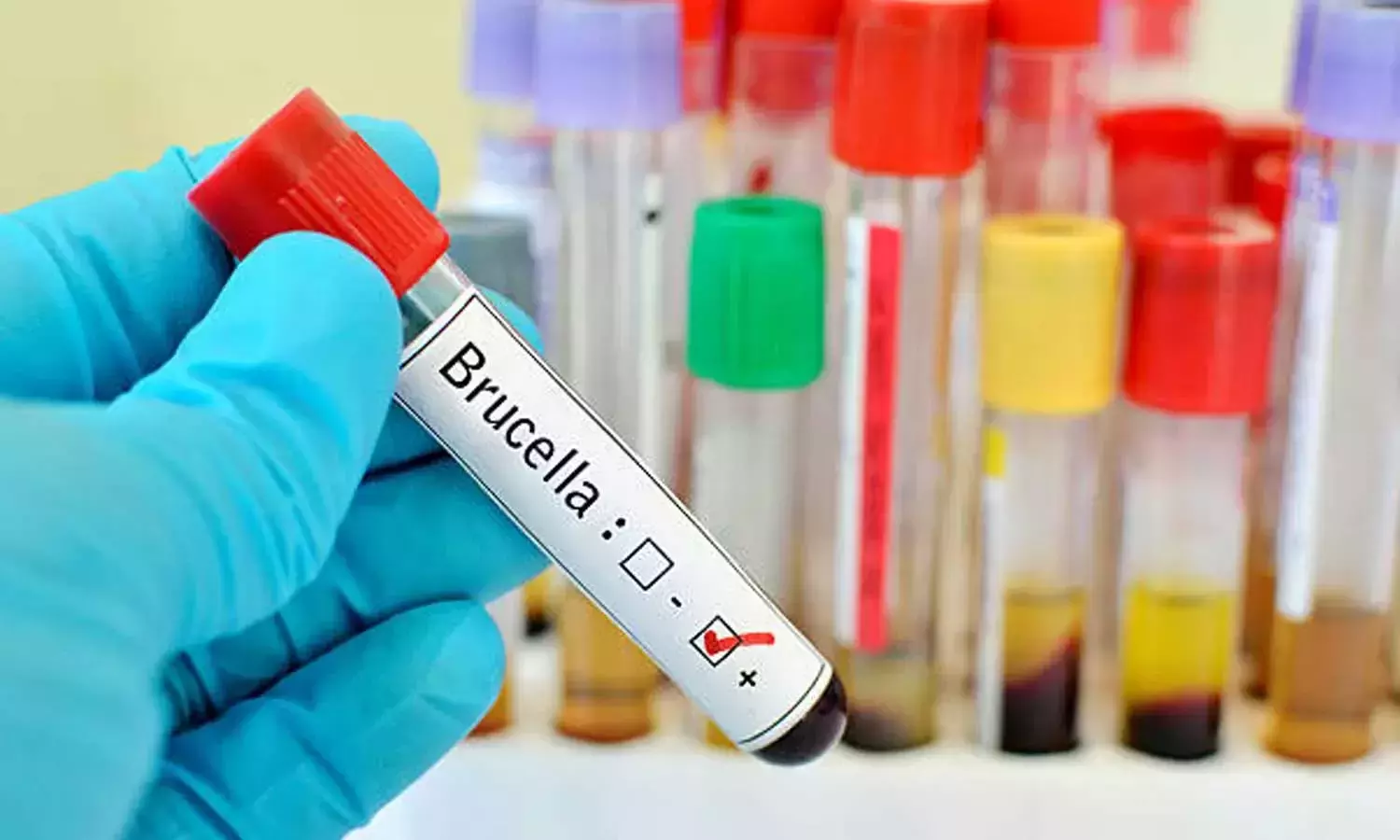 ബ്രൂസെല്ലോസിസ്: ഉറവിടം കണ്ടെത്താനായില്ല ബ്രൂസെല്ലോസിസ്: ഉറവിടം കണ്ടെത്താനായില്ല