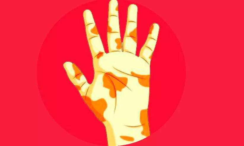 ബാലമിത്ര 2.0 കാമ്പയിൻ; മൂന്ന് കുട്ടികളടക്കം 18 പേർക്ക് കുഷ്ഠരോഗം സ്ഥിരീകരിച്ചു