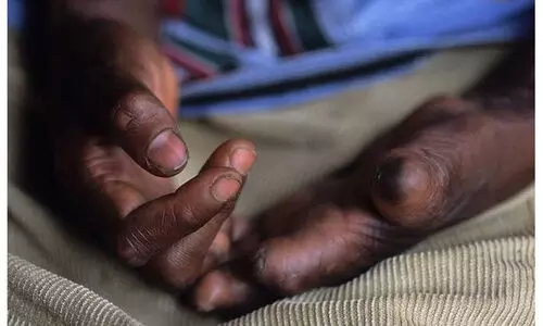 കു​ഷ്ഠ​രോ​ഗം: ആ​ശ​ങ്ക​പ്പെ​ടേ​ണ്ട​തി​ല്ലെ​ന്ന് ജി​ല്ല മെ​ഡി​ക്ക​ൽ ഓ​ഫി​സ​ർ