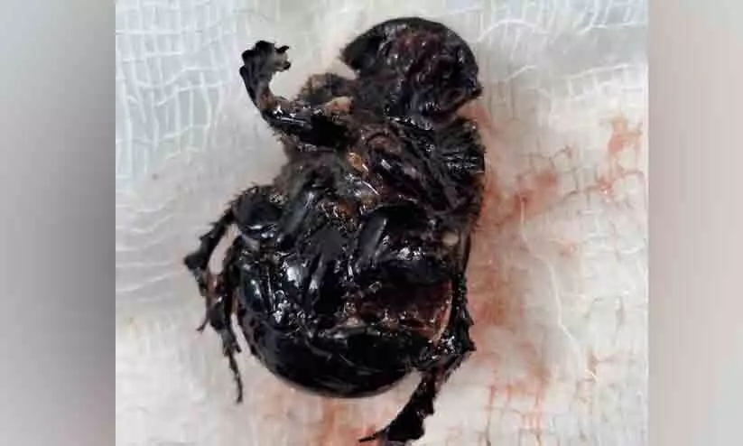 Kompanchelli beetle in the throat of a toddler who had difficulty breathing