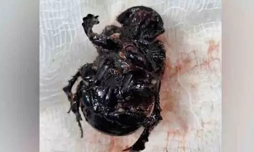 Kompanchelli beetle in the throat of a toddler who had difficulty breathing