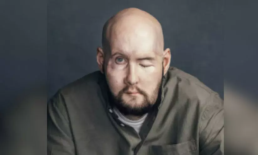 eye-face transplant surgery