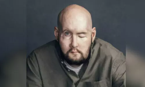 eye-face transplant surgery