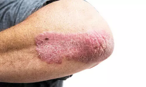 സോറിയാസിസ്: പകരില്ല, ചികിത്സ വേണം