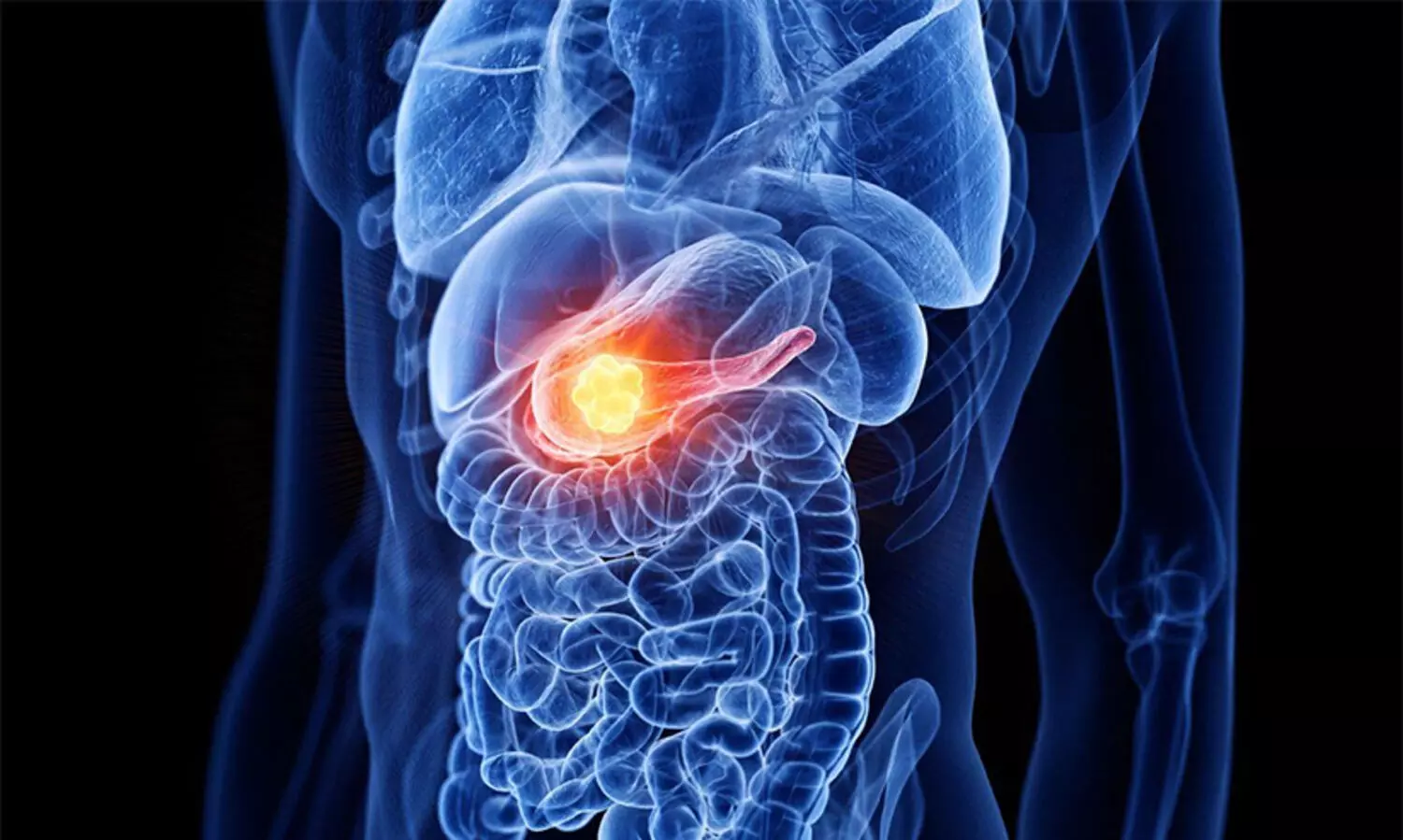 pancreatic cancer