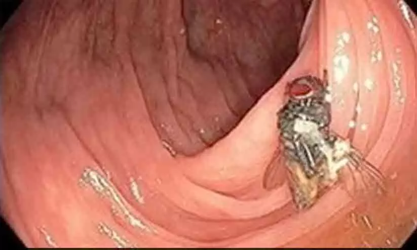 63കാരന്‍റെ വൻകുടലിനുള്ളിൽ കേടുകൂടാതെ ഈച്ചയെ കണ്ടെത്തി