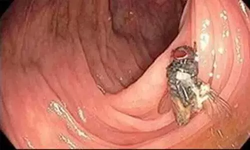 63കാരന്‍റെ വൻകുടലിനുള്ളിൽ കേടുകൂടാതെ ഈച്ചയെ കണ്ടെത്തി