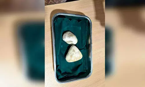 stone removed stone removed