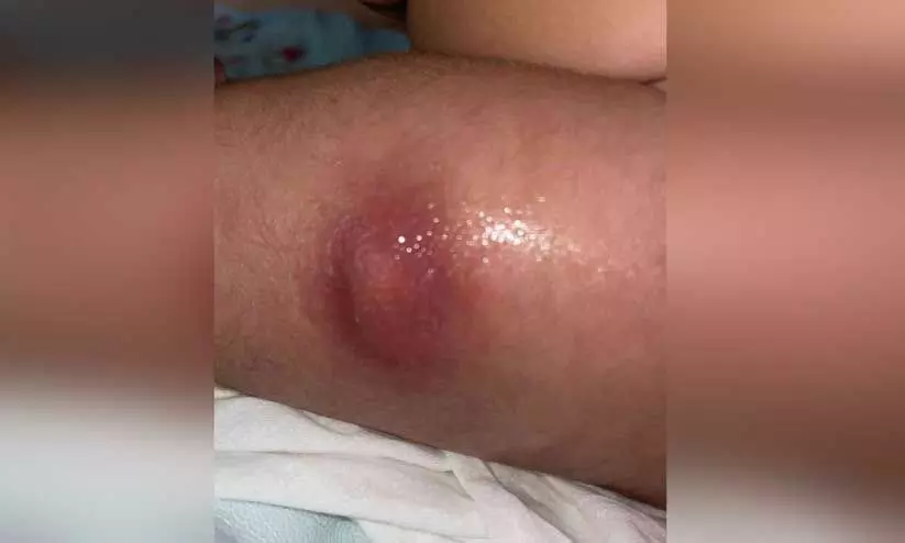 കു​ത്തി​വെ​പ്പി​നെ​തു​ട​ർ​ന്ന് കു​ഞ്ഞി​ന്റെ കാ​ലി​ലു​ണ്ടാ​യ അ​ണു​ബാ​ധ