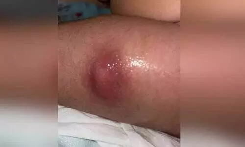 കു​ത്തി​വെ​പ്പി​നെ​തു​ട​ർ​ന്ന് കു​ഞ്ഞി​ന്റെ കാ​ലി​ലു​ണ്ടാ​യ അ​ണു​ബാ​ധ