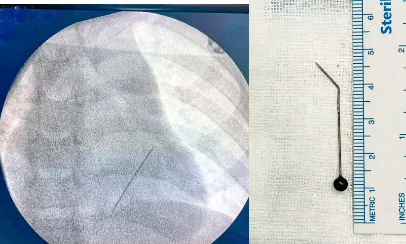 ഏഴു വയസ്സുകാരന്റെ ശ്വാസകോശത്തിൽ കുടുങ്ങിയ സൂചി പുറത്തെടുത്തു ഏഴു വയസ്സുകാരന്റെ ശ്വാസകോശത്തിൽ കുടുങ്ങിയ സൂചി പുറത്തെടുത്തു