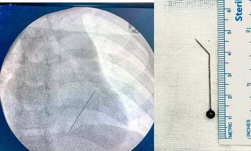 ഏഴു വയസ്സുകാരന്റെ ശ്വാസകോശത്തിൽ കുടുങ്ങിയ സൂചി പുറത്തെടുത്തു