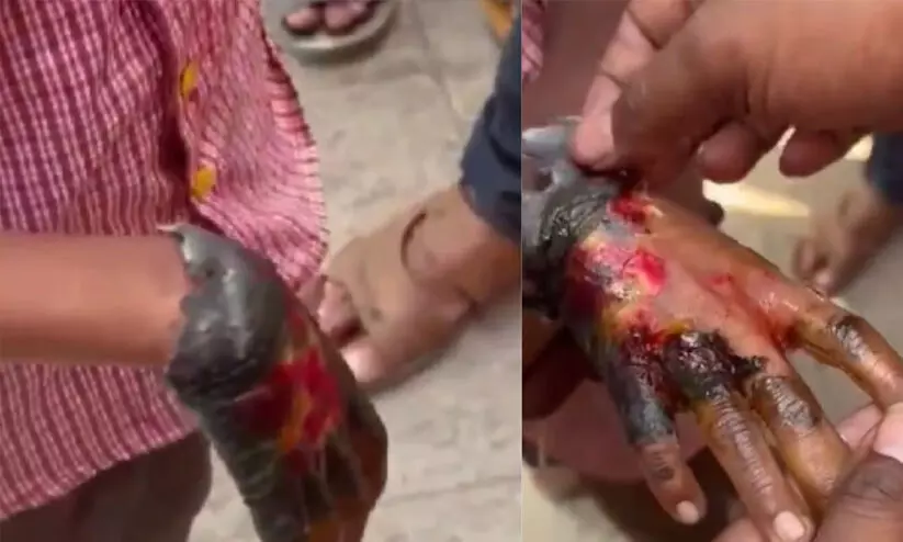 പുണെയിൽ ഭിക്ഷാടന തട്ടിപ്പ്; കുട്ടിയുടെ കൈയിൽ വ്യാജ മുറിവുണ്ടാക്കിയയാളെ പിടികൂടി പുണെയിൽ ഭിക്ഷാടന തട്ടിപ്പ്; കുട്ടിയുടെ കൈയിൽ വ്യാജ മുറിവുണ്ടാക്കിയയാളെ പിടികൂടി