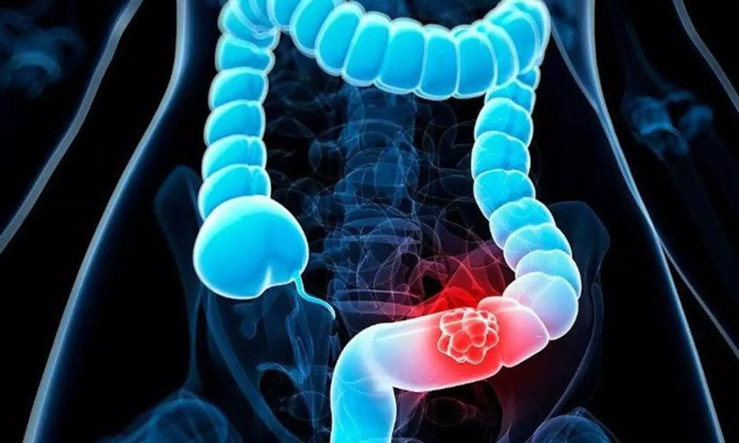 colon cancer