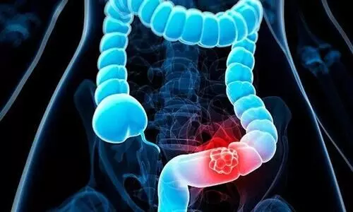 colon cancer colon cancer