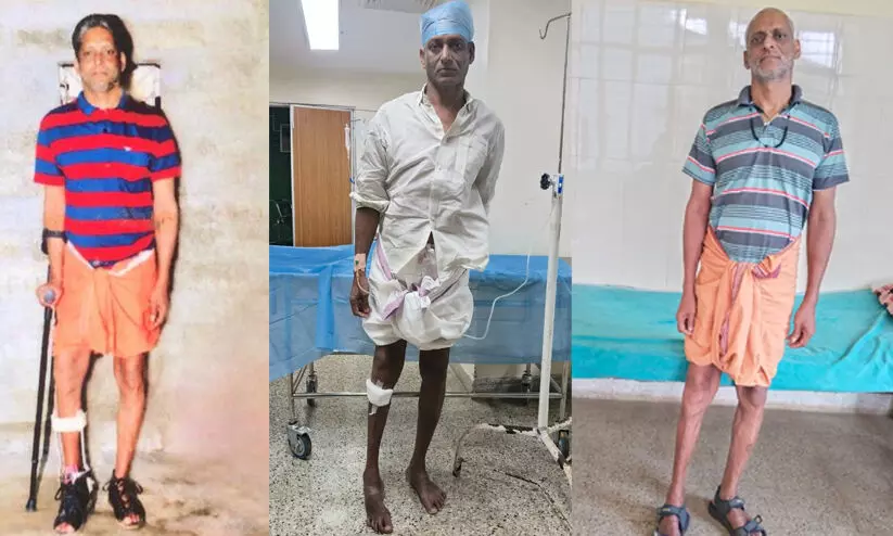 എറണാകുളം സർക്കാർ മെഡിക്കൽ കോളജിൽ അപൂർവ ശസ്ത്രക്രിയ; ഇടുപ്പെല്ല് മാറ്റി സ്ഥാപിച്ചു എറണാകുളം സർക്കാർ മെഡിക്കൽ കോളജിൽ അപൂർവ ശസ്ത്രക്രിയ; ഇടുപ്പെല്ല് മാറ്റി സ്ഥാപിച്ചു