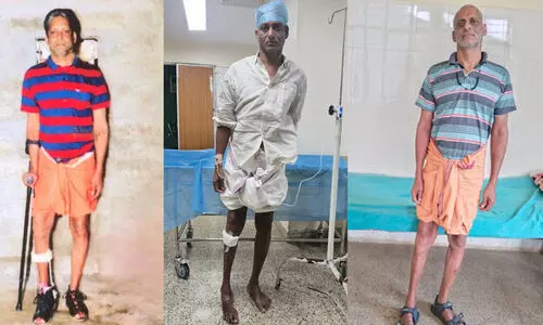 എറണാകുളം സർക്കാർ മെഡിക്കൽ കോളജിൽ അപൂർവ ശസ്ത്രക്രിയ; ഇടുപ്പെല്ല് മാറ്റി സ്ഥാപിച്ചു