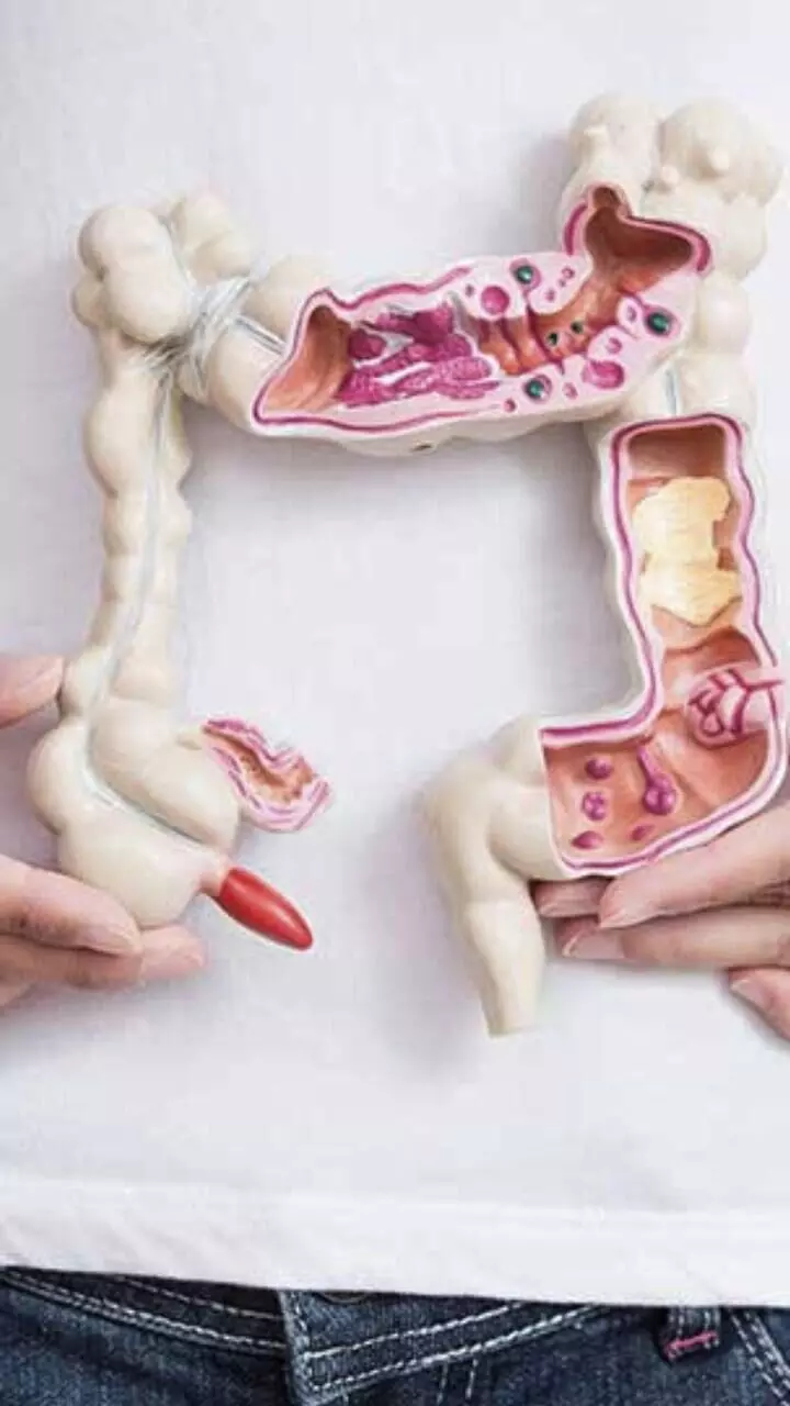 യുവാക്കളിൽ വൻകുടൽ കാൻസർ പെരുകുന്നു; ലക്ഷണങ്ങൾ ഇവ...