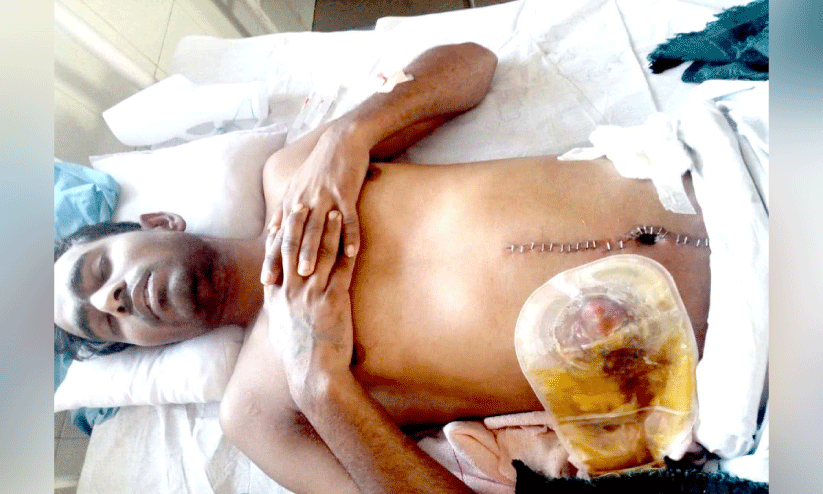 സം​ഘം ചേ​ർ​ന്ന് മ​ർ​ദ​നം; അ​ന്ത​ർ സം​സ്ഥാ​ന തൊ​ഴി​ലാ​ളി​ക്ക് ഗു​രു​ത​ര പ​രി​ക്ക്