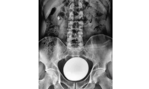 മൂത്രാശയക്കല്ല്: കാരണങ്ങളും പരിഹാരവും