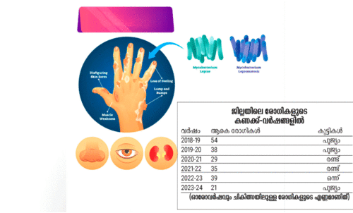 കുഷ്ഠരോഗം നാട്ടിലിപ്പോഴുമുണ്ട് വേണം, കരുതൽ