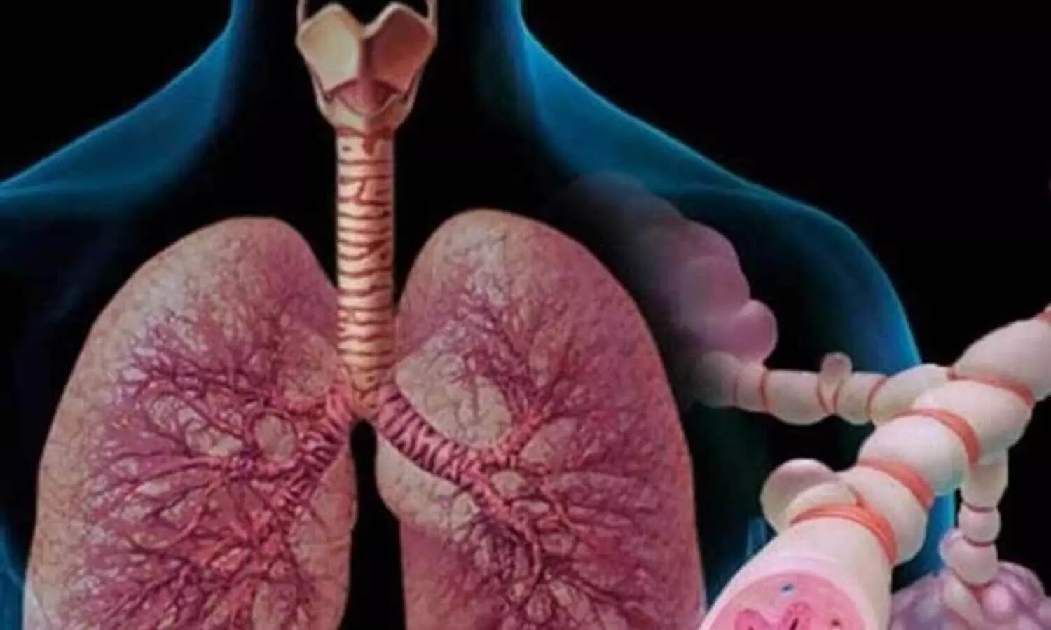 കോവിഡാനന്തരമുള്ള ശ്വാസകോശ പ്രശ്നങ്ങൾ ഏറ്റവും കൂടുതൽ ഇന്ത്യക്കാരിലെന്ന് പഠനം