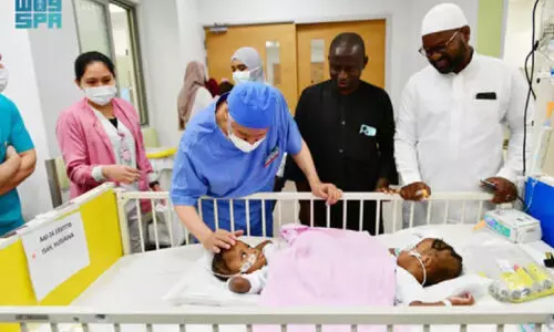 നൈജീരിയൻ സയാമീസ് ഇരട്ടകളെ വേർപ്പെടുത്തൽ ശസ്​ത്രക്രിയ ആരംഭിച്ചു