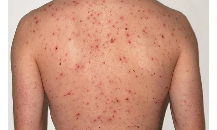 വേനലിൽ ചിക്കൻപോക്സിനെതിരെ ആരോഗ്യവകുപ്പിന്റെ ജാഗ്രതാനിർദേശം വേനലിൽ ചിക്കൻപോക്സിനെതിരെ ആരോഗ്യവകുപ്പിന്റെ ജാഗ്രതാനിർദേശം