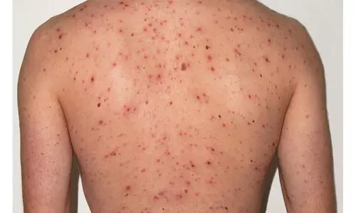 വേനലിൽ ചിക്കൻപോക്സിനെതിരെ ആരോഗ്യവകുപ്പിന്റെ ജാഗ്രതാനിർദേശം