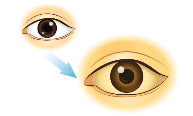 പോത്തുകല്ല്, എടക്കര പഞ്ചായത്ത്;   മഞ്ഞപ്പിത്തം നിയന്ത്രണ വിധേയമെന്ന് കലക്ടർ