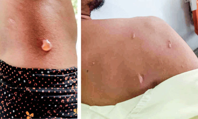 വ​ഴി​ക്ക​ട​വി​ൽ മൂ​ന്നു​പേ​ർ​ക്ക് സൂ​ര‍്യാ​ത​പ​മേ​റ്റു