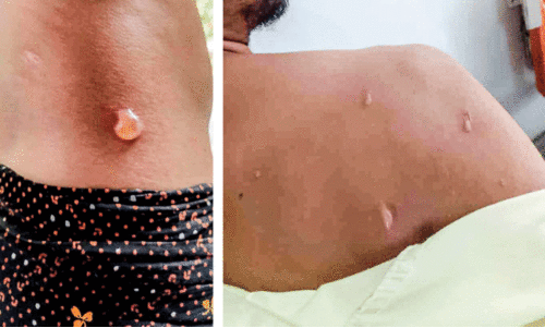 വ​ഴി​ക്ക​ട​വി​ൽ മൂ​ന്നു​പേ​ർ​ക്ക് സൂ​ര‍്യാ​ത​പ​മേ​റ്റു