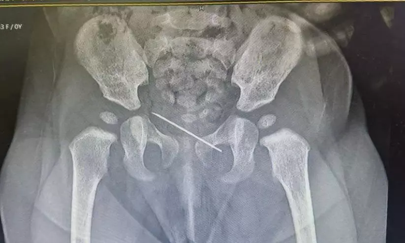 നാഭിയിൽ സിറിഞ്ചിന്റെ ഭാഗം; പിഞ്ചുകുഞ്ഞിനെ രക്ഷിച്ച് അൽ ഹിലാൽ ഹെൽത്ത് കെയർ ഗ്രൂപ്പ് നാഭിയിൽ സിറിഞ്ചിന്റെ ഭാഗം; പിഞ്ചുകുഞ്ഞിനെ രക്ഷിച്ച് അൽ ഹിലാൽ ഹെൽത്ത് കെയർ ഗ്രൂപ്പ്