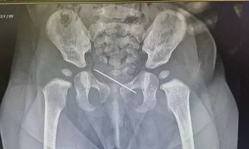 നാഭിയിൽ സിറിഞ്ചിന്‍റെ ഭാഗം; പിഞ്ചുകുഞ്ഞിനെ രക്ഷിച്ച്​ അൽ ഹിലാൽ ഹെൽത്ത് കെയർ ഗ്രൂപ്പ്