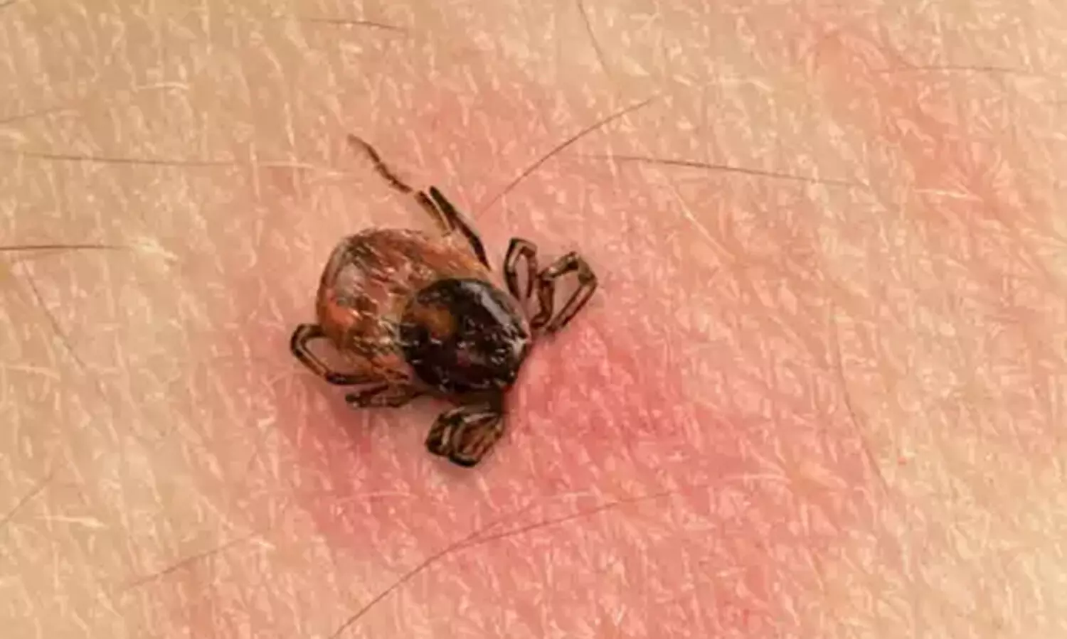 Lyme disease