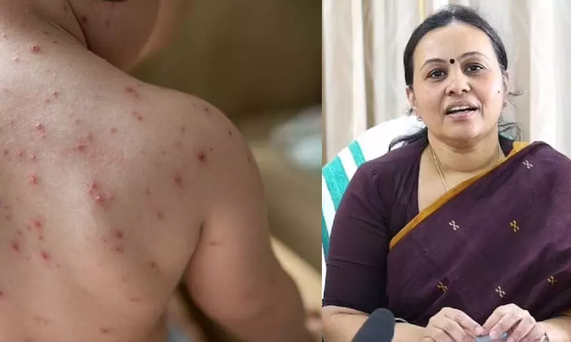 വേനല്‍ക്കാല രോഗങ്ങള്‍: ചിക്കന്‍ പോക്‌സിനെതിരെ ജാഗ്രത പാലിക്കണമെന്ന് വീണ ജോർജ്