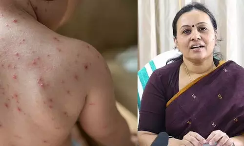 വേനല്‍ക്കാല രോഗങ്ങള്‍: ചിക്കന്‍ പോക്‌സിനെതിരെ ജാഗ്രത പാലിക്കണമെന്ന് വീണ ജോർജ്