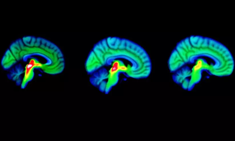 പാര്ക്കിന്സണ്സിനെ അറിയാം, അതിജീവിക്കാം പാര്ക്കിന്സണ്സിനെ അറിയാം, അതിജീവിക്കാം